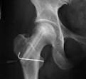 Avascular <b>Necrosis</b> of <b>Femoral</b>