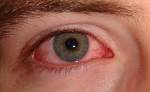 Pink eye, or <b>conjunctivitis</b>,