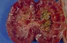 <b>Lithiasis</b> of the renal pelvis