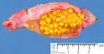 salivary <b>lithiasis</b>