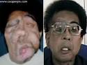 Before and After FACE TRANSPLANT Picture