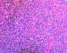<b>Plasmacytoma</b>