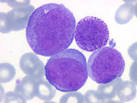La <b>leucemia</b> mieloide <b>crónica</b>