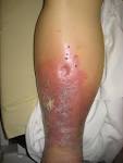 File:Pitting Edema2008.jpg