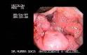 of the large bowel with
