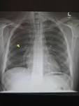 File:PneumoMediastinum2008.jpg