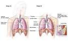 Two-panel drawing of stage I <b>non</b>-<b>small cell lung cancer</b>. First panel