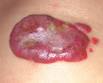 Blueberry muffin baby: A pictoral differential diagnosis
