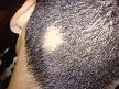 <b>Alopecia areata</b>.