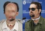 First U.S. FACE TRANSPLANT Turned Out Pretty Well