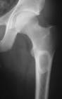 <b>Fibrous dysplasia</b>, <b>monostotic</b>