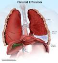 Symptoms of <b>pleurisy</b> include: