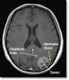<b>Meningioma</b> MRI