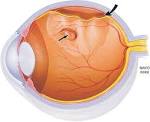 <b>Retinal Detachment</b>: Imaging of Surgical Treatments and Complications1