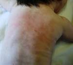 <b><b>Oftalmia Dei Neonati</b></b>