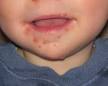 Hand, foot and <b>mouth disease</b>