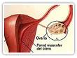 Tumores <b>ováricos</b>