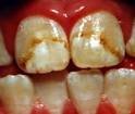 What are the reasons why <b>teeth</b> may get <b>discolored</b> and how to
