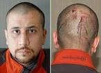 Photos of George Zimmerman's Injuries Released; Evidence Mixed For ...