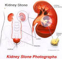 <b>Lithiasis</b> : A Review