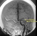 <b>Cerebral angiography</b> provides
