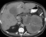 <b>Pheochromocytoma</b>: An Imaging Chameleon1