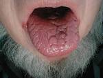 pictures of <b>glossitis</b>
