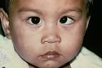 <b>esotropia</b>. Related pictures