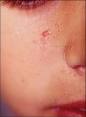 <b>Esclerosis tuberosa</b>