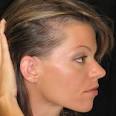 onset of <b>alopecia</b> areata.