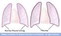 <b>Pleurisy</b>