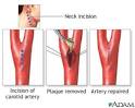 Carotid artery surgery - series