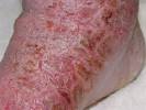 Morgellons Disease Is Silicone