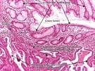Colorectal <b>Adenocarcinoma</b> Photos and a listing of clinical trials