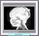 <b>encefalocele</b> es evidente,