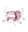 <b>gland tumors</b> form,