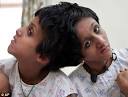 Saba and Farah Shakeel are joined at the skull and have been suffering ... - f4cb8d4e336fcc1f35f3cab1_conjoined%20twins1