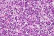 Micrograph of a <b>hepatoblastoma</b>