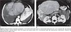 <b>Hiperplasia nodular focal</b>