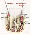 <b>Periodontal Diseases</b> - Torrance CA | Arta Farahmand, DDS