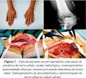 e <b>ossificação heterotópica</b>