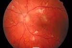 <b>Malignant hypertensive</b>