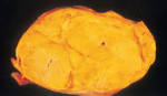 <b>Adrenal</b> Masses: MR Imaging Features with Pathologic Correlation1