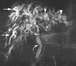 <b>Hemobilia</b> after a percutaneous