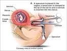 Surgical Abortions | SexInfo Online