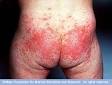treatment of <b>diaper rash</b>