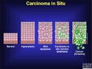 <b>Carcinoma</b> in <b>Situ</b>