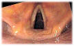 seen during <b>laryngoscopy</b>