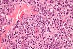 File:Anaplastic <b>large cell</b>