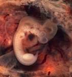 File:<b>Tubal Pregnancy</b> with